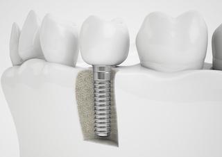 Hartford CT Dental Implants